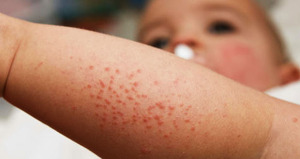 Virus ataca el Noreste: Alerta ante enfermedad de manos, pie y boca